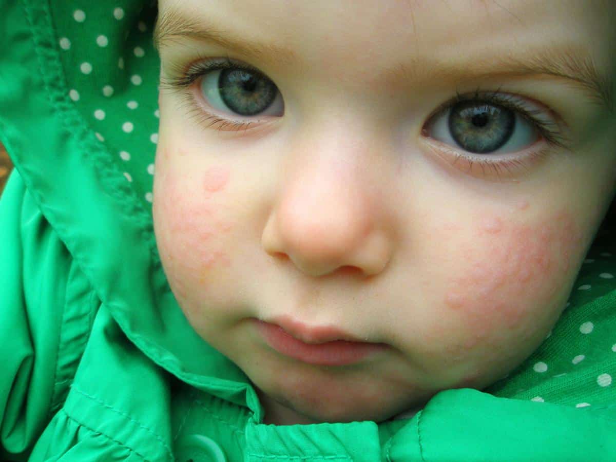 Аллергия на фисташки. Высыпания на лице у ребенка. Пищевая аллергия на лице у ребенка.