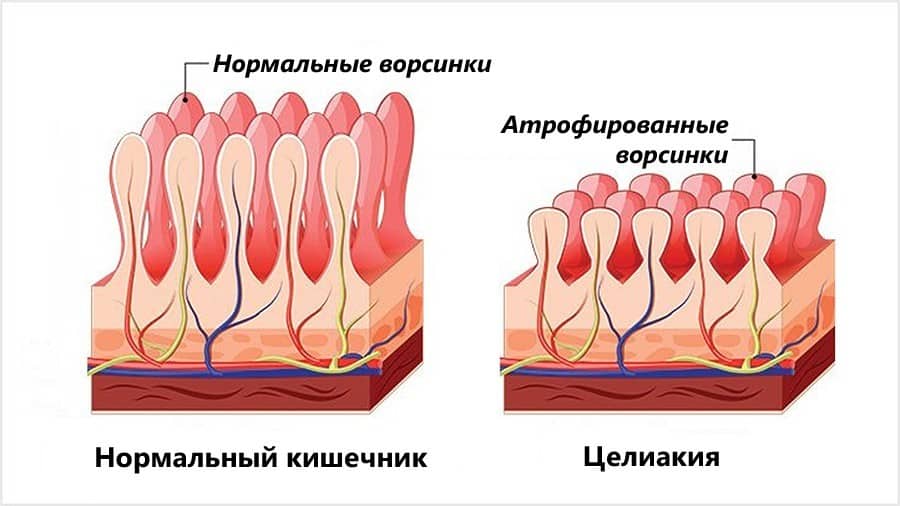 Стул при целиакии у детей