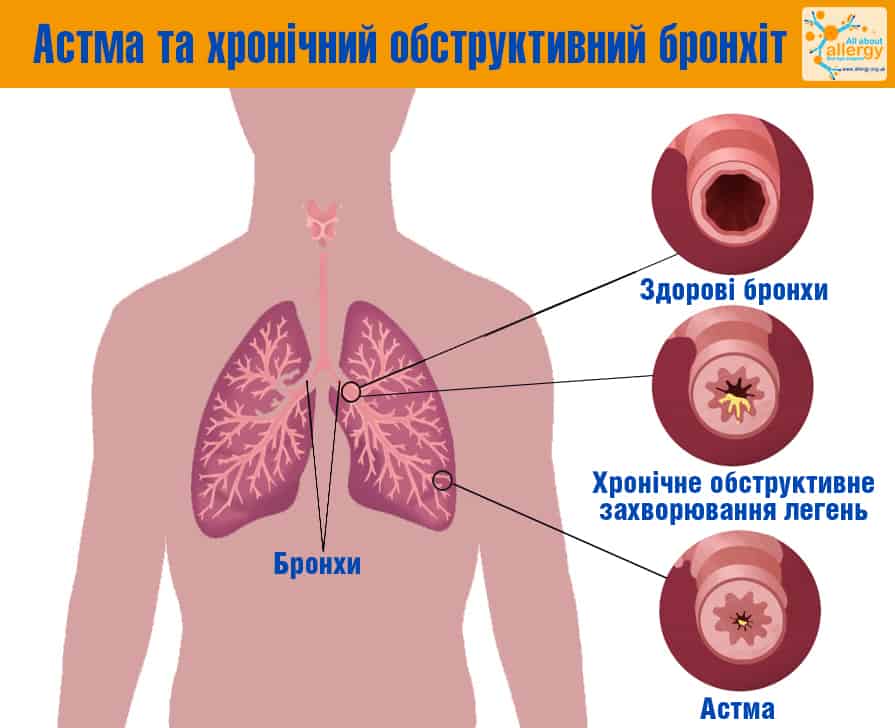 Бронхиальная астма у ребенка: диагностика и лечение