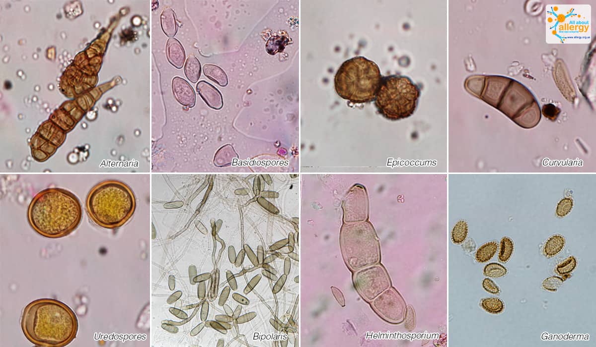 На коже обнаружены споры. Кандида в Кале при микроскопии. Микроскопия кала дрожжи. Микроскопия кала дрожжевые грибы. Споры грибов в Кале микроскопия.