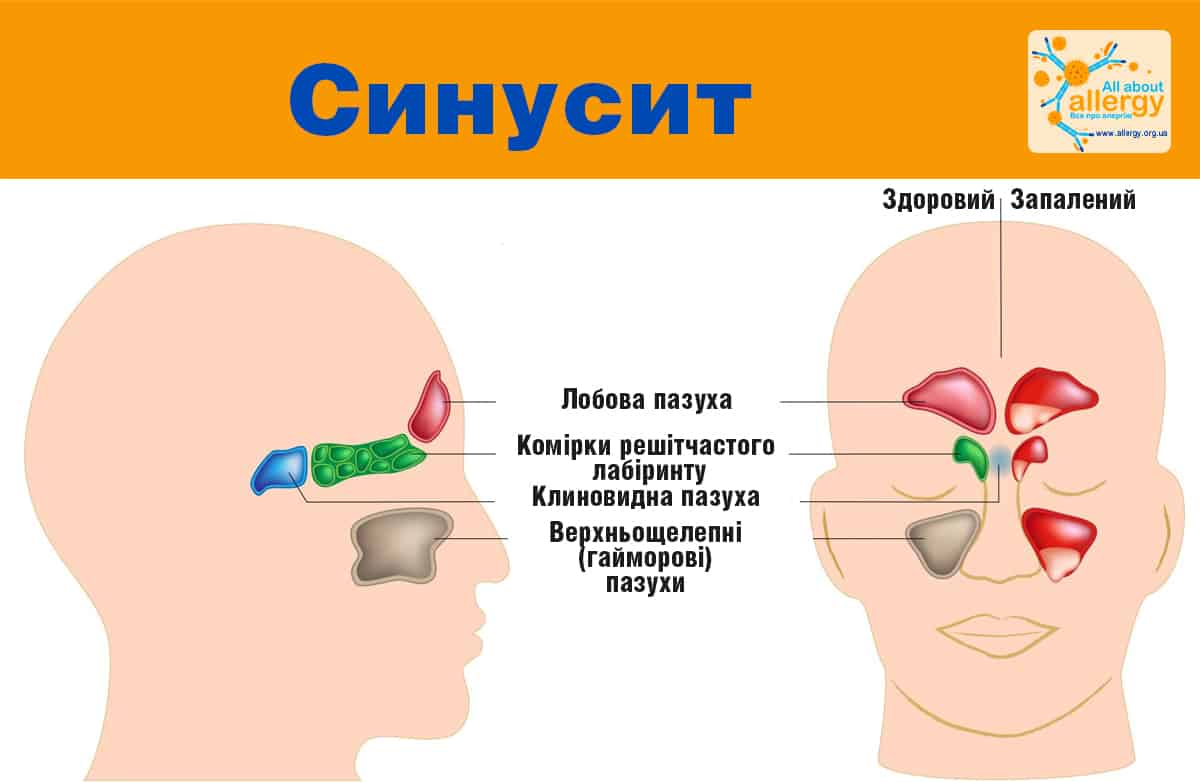 Лечение аллергического ринита в СПб