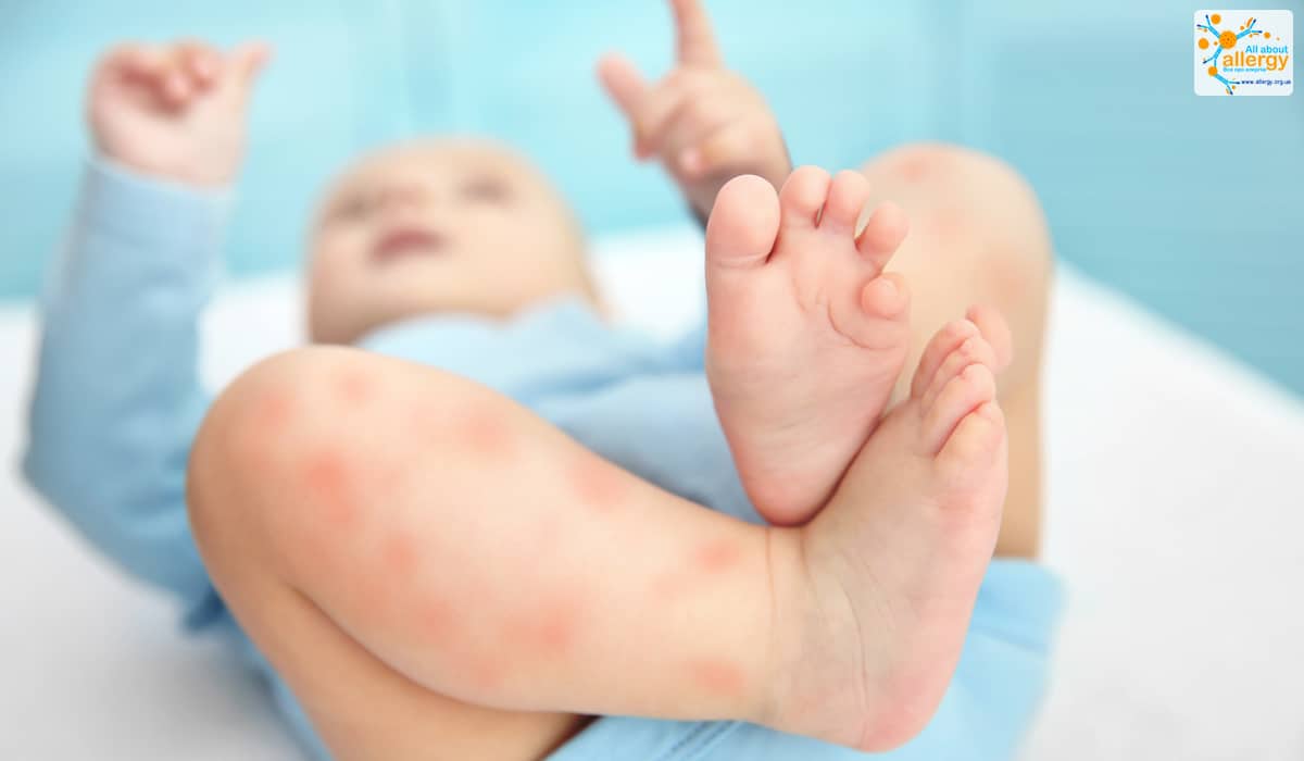 Алергія у немовлят фото
