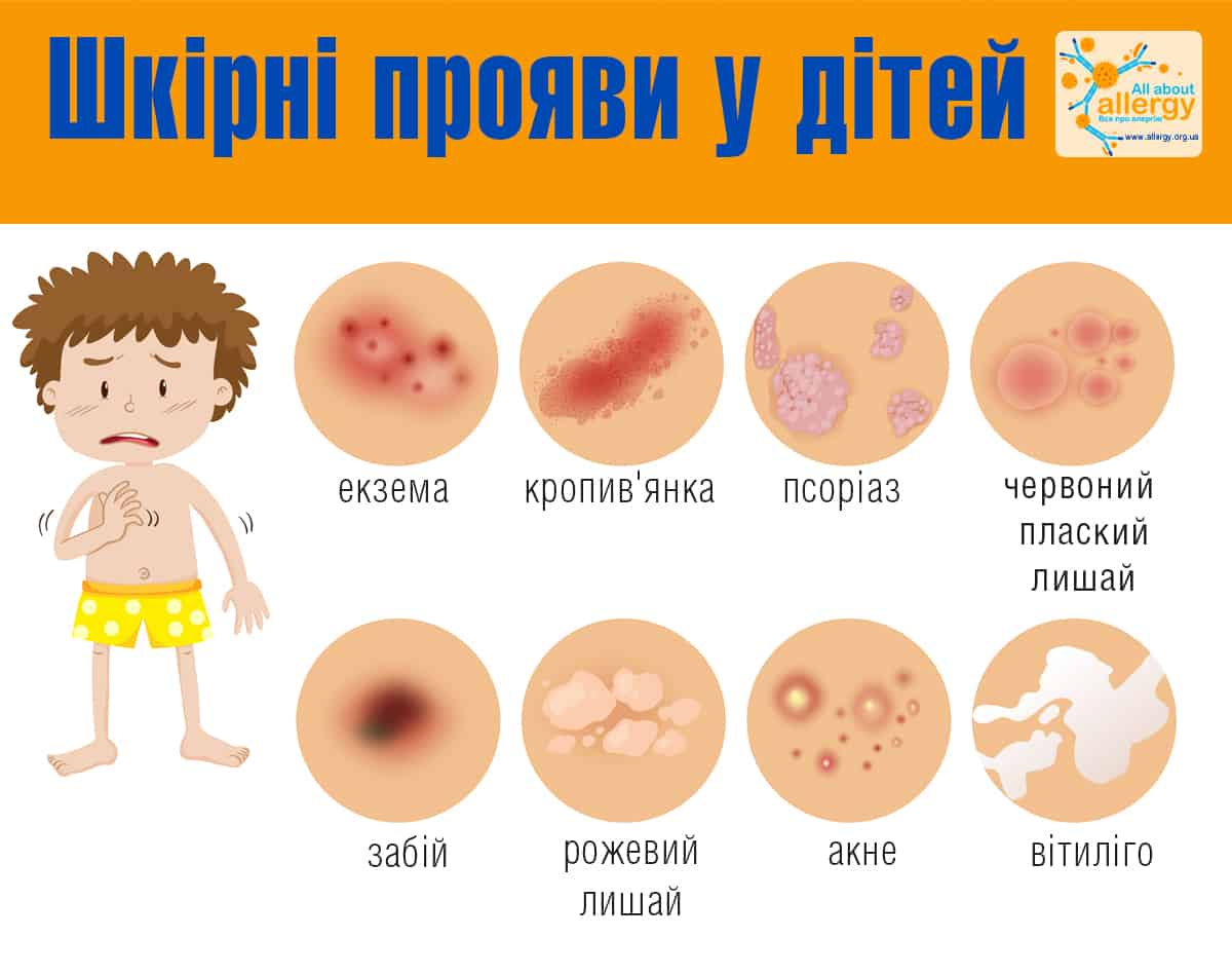 Що робити, якщо у дитини виникла алергія? - Все про алергію