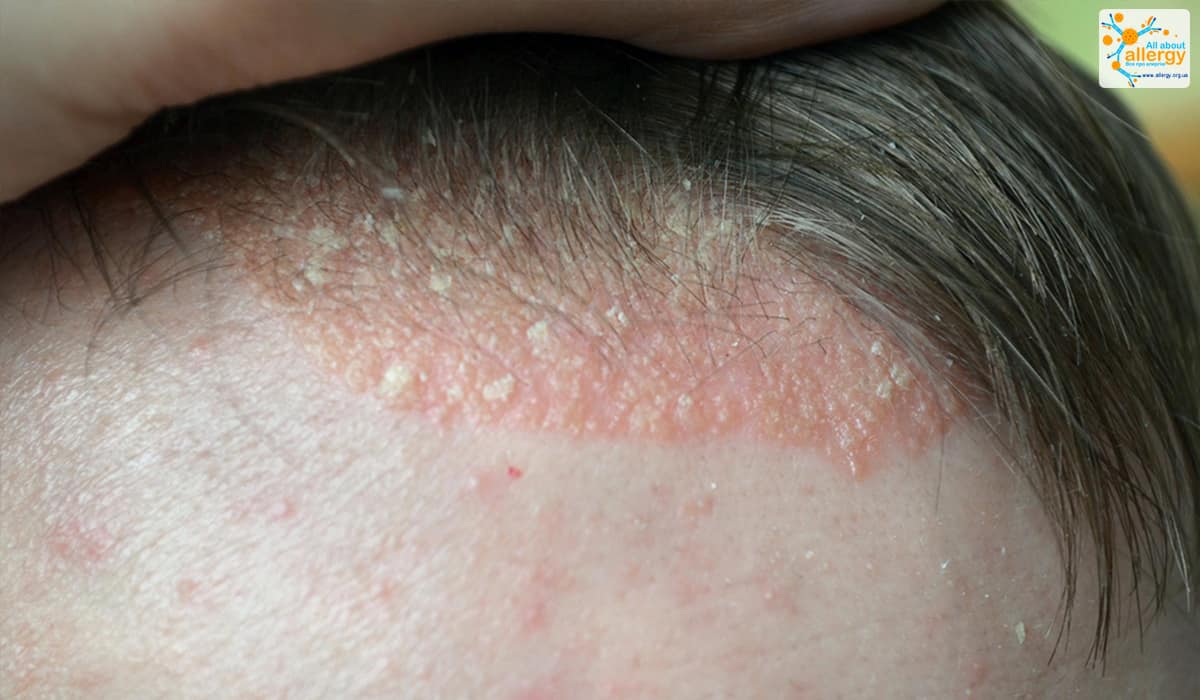 Фотографии заболеваний кожи, дополнительные пояснения