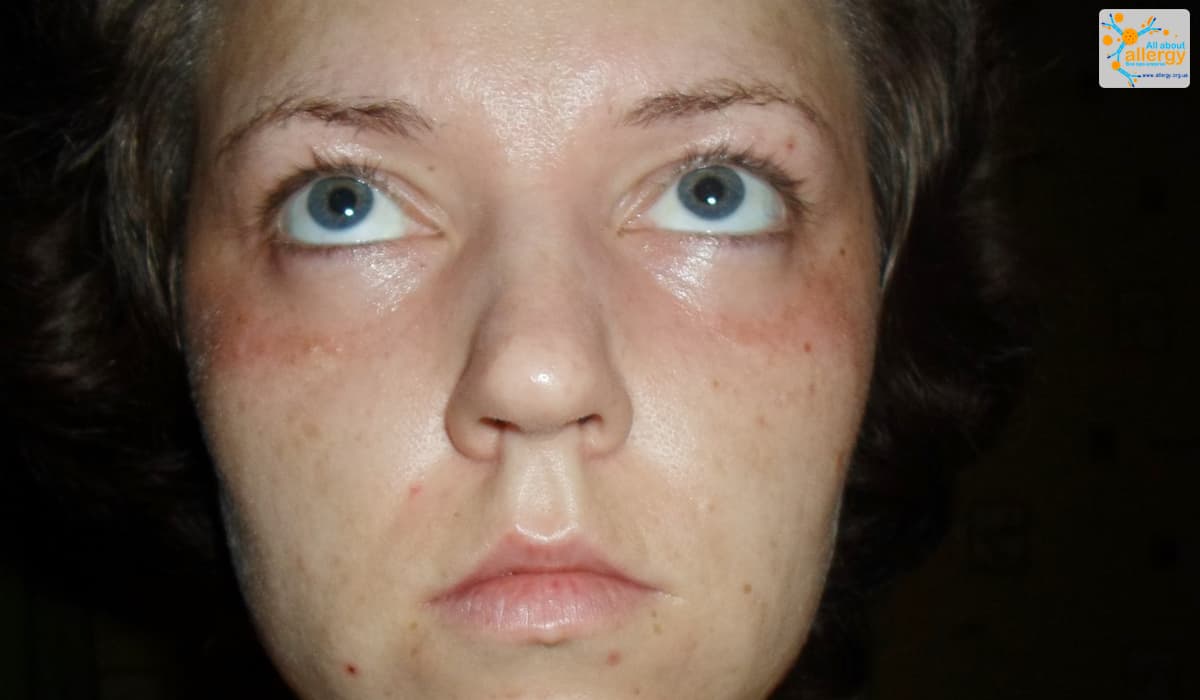 Аллергия - симптомы и лечение, признаки, причины и диагностика