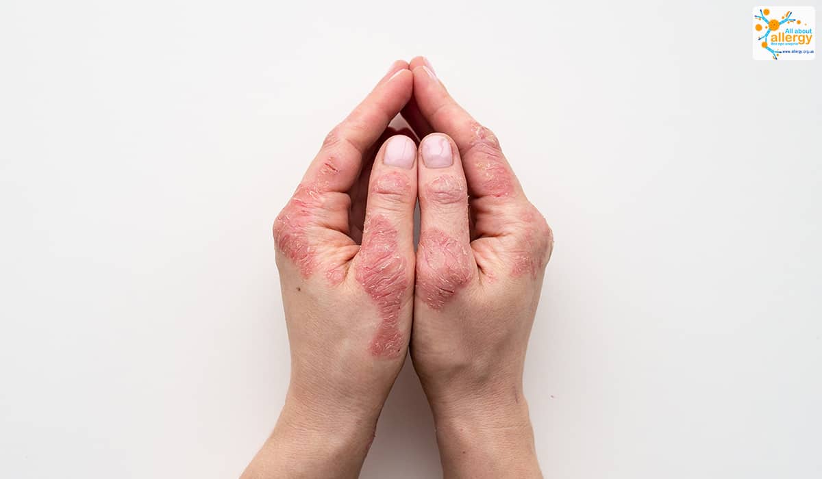 Что делать, если трескается кожа на сгибах пальцев?
