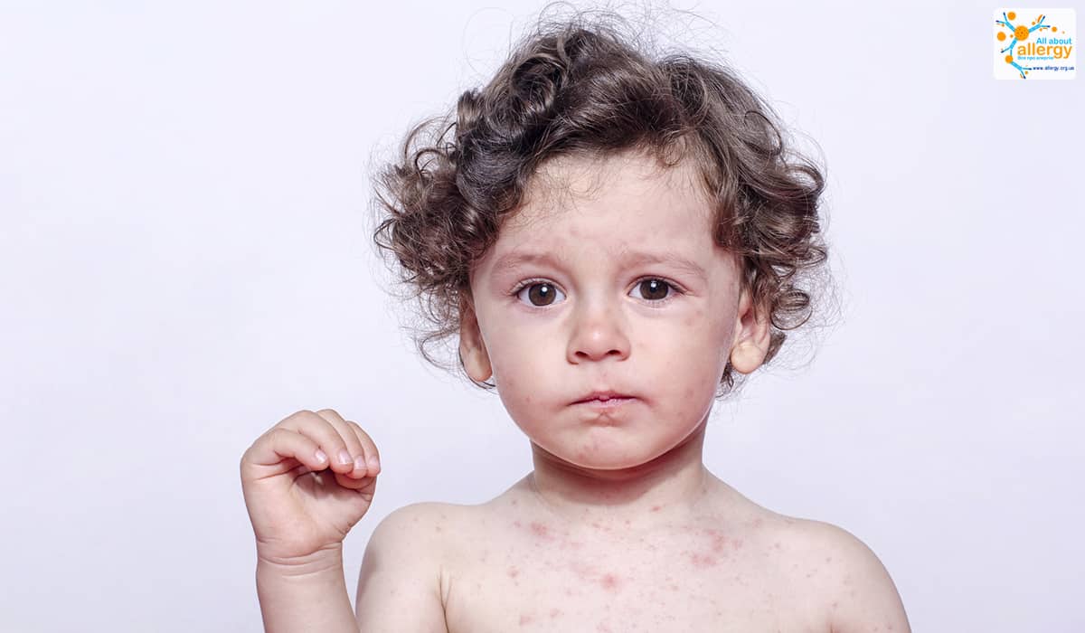 Види алергії на шкірі фото