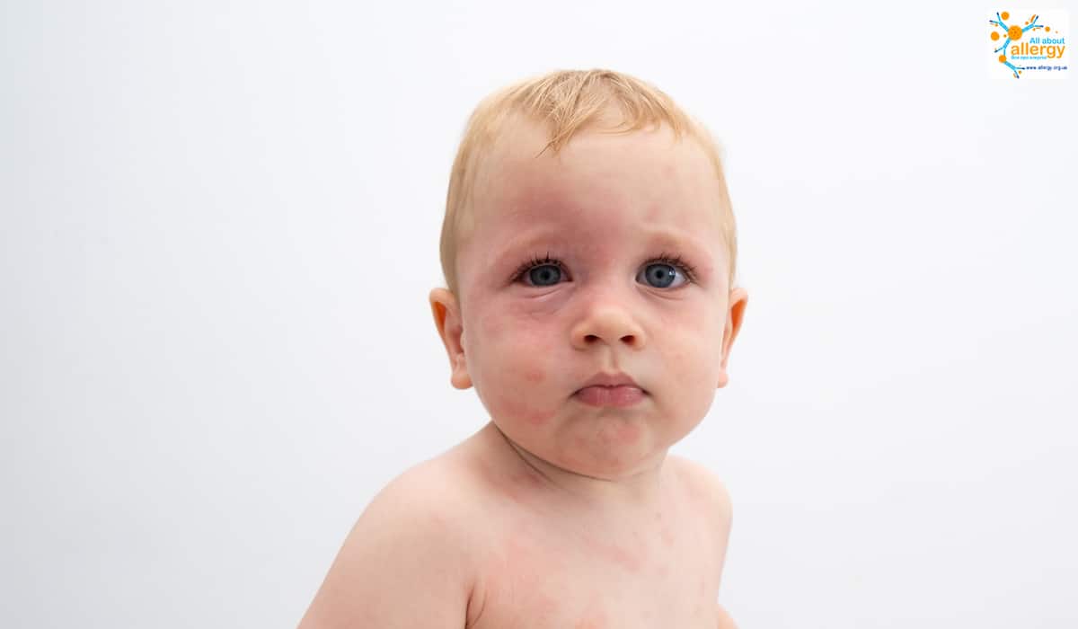 Алергія на обличчі у дитини: кропив’янка