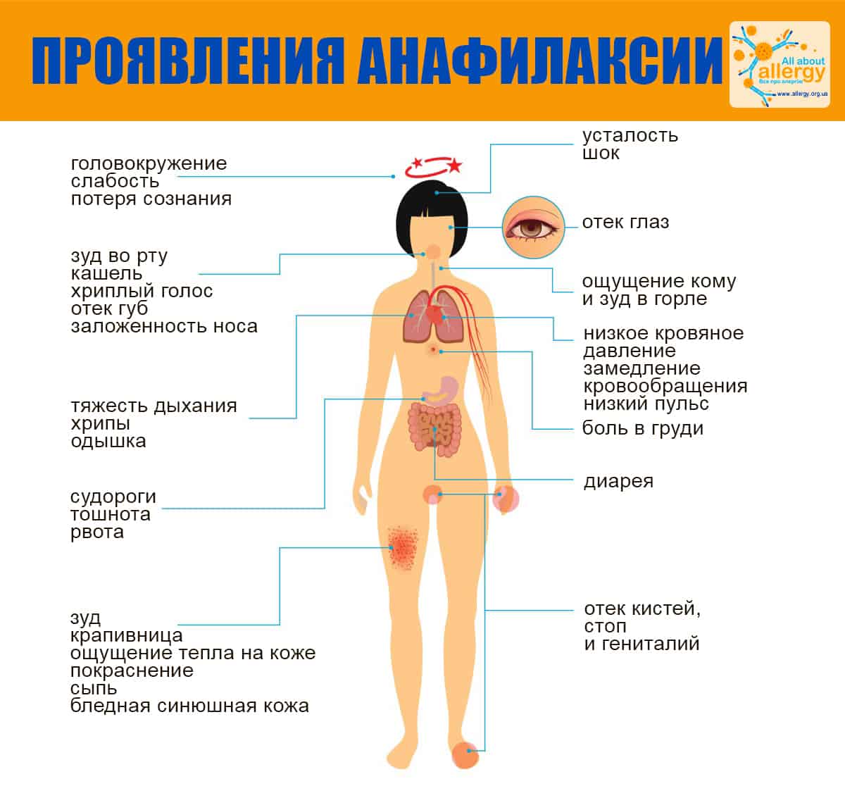 Симптомы анафилаксии инфографика
