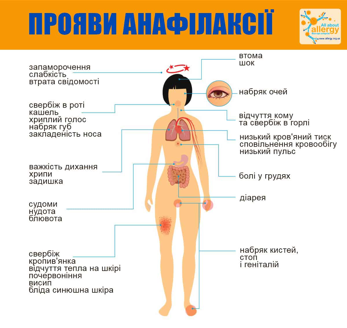 Симптоми анафілаксії інфографика