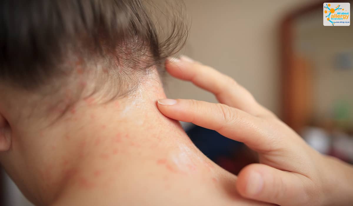 Эритема на лице и шее: причины, симптомы и лечение