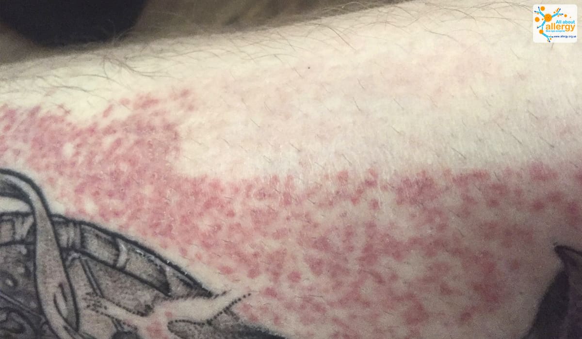 Почему возникает аллергия на тату-краску? Особенности состава пигментов